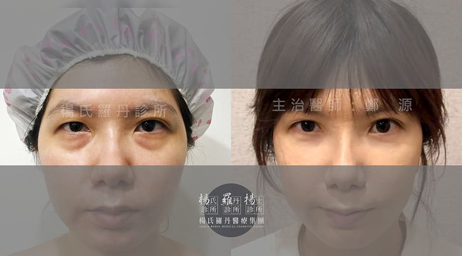 眼袋淚溝,黑眼圈 楊氏羅丹 醫學美容